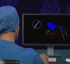 RSIP Vision introduced a new coronary artery modeling technology that enables quick and accurate reconstruction of the coronary vasculature during angiography into a 3D model in the cath lab.