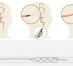 Rapid Medical's TigerTrieve stent-retriever neuro thrombectomy system.
