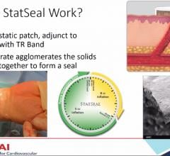 The STAT2 trial used a combination of the Biolife Statseal potassium ferrate hemostatic patch and a Terumo TR Band to reduce radial access arteriotomy site hemostasis by 50 percent.