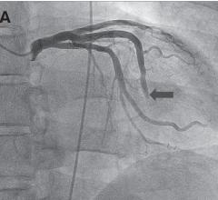 Study Finds Effective Treatment for Coronary Slow Flow