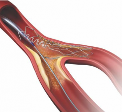 tryton side branch stent, bifurcation stenting, Cardinal Health