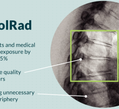 The ControlRad device collimates the area of interest where the physicians are working, and reduces the dose significantly to peripheral areas in the image. 