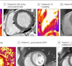 Vaccine-associated myocarditis shows a similar injury pattern on cardiac MRI compared to other causes of myocarditis, but abnormalities are less severe, according to a new study published in the journal Radiology.