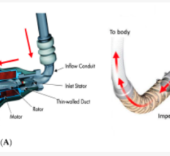 Pump housing and impeller design. (A): (left) Axial flow pump: HeartMate II LVAD (taken from Figure 2 in the HeartMate II left ventricular assist system instructions for use). (B) (right) Centrifugal flow pump: HeartWare assist device (taken from Figure 2 in the HeartWare assist device patient manual).