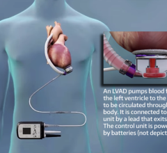 About one-fifth of implants of left ventricular-assist devices have the complication of right heart failure. Abbott Laboratories (adapted)