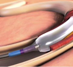 Late-breaking clinical presentations at VIVA show IN.PACT Admiral drug-coated PTA balloon catheter outperforms bare metal stents; maintains performance in real-world setting
