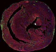 A mouse heart with immune infiltrates leading to ICI-myocarditis. Image courtesy of UCSF
