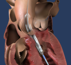 Impella ECP, the world's smallest heart pump, is placed percutaneously into the heart's left ventricle. (Graphic: Business Wire)