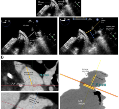The Society for Cardiovascular Angiography and Interventions (SCAI) and the Heart Rhythm Society (HRS) released an updated expert consensus statement on transcatheter left atrial appendage closure (LAAC)