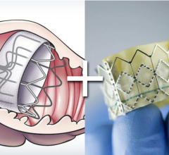 WATCH TAVR trial presented at the Transcatheter Cardiovascular Therapeutics annual conference 