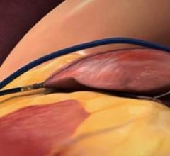 In the LAAOS III trial, surgeons could seal off the LAA during the open heart procedure using sutures, staples or approved closure devices. The image shows a SentraHeart lasso type LAA occluder about to seal off the LAA from the outside of the heart.  #ACC21 #ACC2021