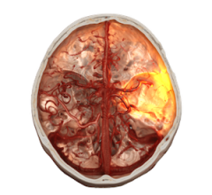 Siemens Healthineers Receives ARPA-H Funding to Develop Remote Endovascular Robotics