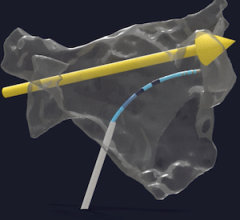 Stereotaxis Finalizes Robocath Acquisition