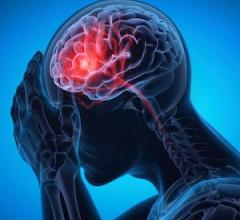 New Research Links Increased Stroke Risk to Cancer Diagnosis