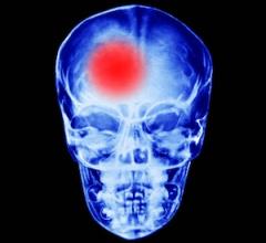 Rapid Response Teams Expedite Imaging, Treatment for Acute Stroke Patients