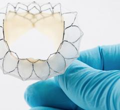 Neovasc Files CE Mark for Tiara TA Transapical Mitral Valve Replacement System. TMVR
