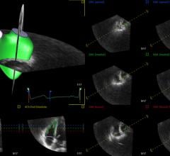 TomTEc, 4D RV-Function, advanced visualization, cardiovascular ultrasound
