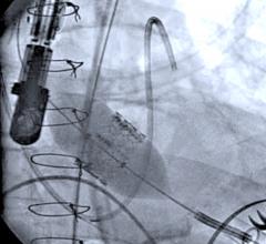 TAVR, TAVI, transcatheter aortic valve replacement, recommendations, Credentialing 