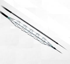 Transit Scientific announced the U.S. Food and Drug Administration (FDA) cleared the XO Score Percutaneous Transluminal Angioplasty (PTA) Scoring Sheath platform for use in iliac, ilio-femoral, popliteal, infra-popliteal and renal arterial plus synthetic and/or native arteriovenous hemodialysis fistula. This is a new type of scoring balloon technology.