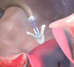 The new generation Abbott TriClip G4 device has gained European and Canadian approvals for transcatheter tricuspid valve repair (TTVR). 