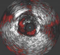 IVUS Demonstrates Greater Visualization of Dissections in iDissection Classification Study