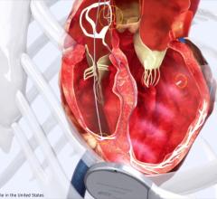 Results from a pivotal clinical trial found a leadless pacemaker can deliver cardiac resynchronization therapy (CRT) among patients who were not able to be treated with conventional CRT and epicardial leads. 