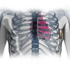 boston scientific s-icd implantable cardioverter defibrillator ICD ep lab