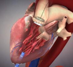 Edwards, Sapien 3, FDA approval, transcatheter heart valve