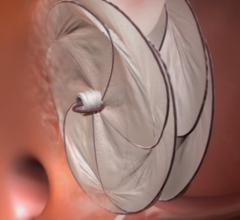 Gore cardioform Septal occluder in trials for PFO closure, PFO occlusion.
