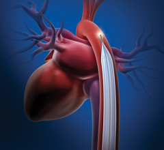Intra-aortic balloon pump (IABP) might help Therapy Aids Cardiogenic Shock Patients