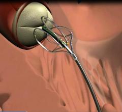 cath lab guidewires heart valve repair medivalve acwire guidewire