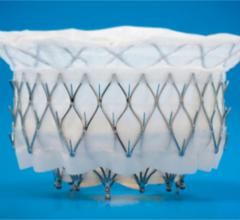 The Medtronic Intrepid transcatheter mitral valve replacement (TMVR) system is being tested in the APOLLO Trial. 