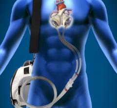 SynCardia Total Artificial Heart, TAH-t, documentary, Retro Reports, The New York Times