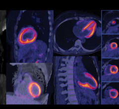 Nuclear myocardial perfusion scan performed on a Biograph Vision positron emission tomography/computed tomography (PET-CT) system from Siemens Healthineers. The image shows good clarity with delineation of the left ventricular edge and papillary muscles without cardiac gating.