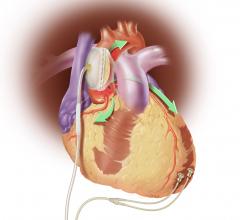 Sunshine Heart, C-Pulse, COUNTER HF, study, FDA, heart failure