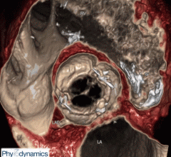 Ziosoft's PhyZiodynamics 4-D processing showing a replaced aortic valve