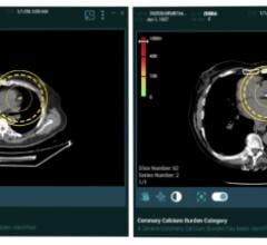 Zebra Medical Vision now offers artificial intelligence (A) medical imaging analytics for its cardiac solution HealthCCSng, which enables the quantification of the coronary artery calcium (CAC) on CT scans as an incidental finding. Zebra gained FDA clearance for the product in September 2021.