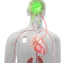 Barostim Baroreflex Activation Therapy is the world’s first FDA-approved device which uses the power of the brain and nervous system to improve symptoms of progressive heart failure 