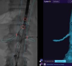 Cydar EV Maps assists in the planning, real-time guidance, and post-procedure review of endovascular surgery. It brings cloud-based AI and computer vision to mobile surgery, enabling reductions in radiation exposure, fluoroscopy time, and procedure time.