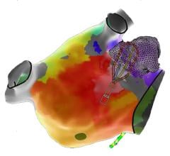 EnSite X EP mapping system with EnSite Omnipolar Technology provides a 360-degree view of the heart, regardless of catheter orientation. FDA Clears New Cardiac Mapping System to Improve How Doctors Treat Abnormal Heart Rhythms