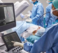 Seamless integration and communication between Philips Ultrasound System - EPIQ CVxi - and Philips Image Guided Therapy System - Azurion - supports efficient fusion-imaging workflow for minimally-invasive treatment of structural heart disease