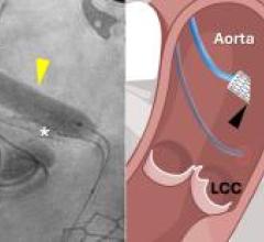 Researchers Perform First Minimally Invasive Coronary Artery Bypass