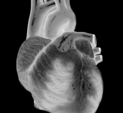 acc pharmaceuticals renal denervation heart valve repair antiplatelet therapy