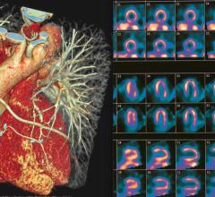 Cardiac CT Given Strong Recommendation as Front-line Imaging of Chest Pain, but the American Society of Nuclear Cardiology (ASNC) did not support the guidelines.  