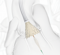CoreValve Evolut R, intermediate risk patients, european approval, CE mark