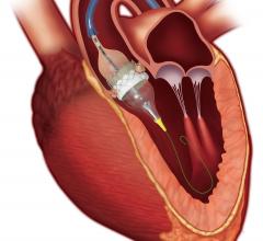 Edwards Sapien 3 TAVI Granted European Approval to Treat Low-risk Patients. TAVR cleared for low risk patients in Europe