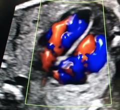This is 3-D blood flow view of blood flow through the chambers of a fetal heart using the GE Healthcare fetalHQ analysis software. #RSNA18 #RSNA #RSNA2018