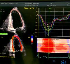 An example of artificial intelligence on the GE Healthcare Vivid E95 system shown at ASE 2019 where the AI automatically pulls in an exam, identifies the left ventricle and myocardial boards and then calculates all the strain measurements in less than 10 seconds. While AI automation can greatly speed workflow, there are questions about the accuracy of AI for the next step in making diagnoses.  #ASE #ASE21 #ASE2021 #AI