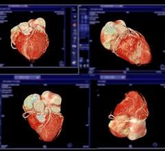 Among the many notable trends in CT, one of the fastest growing is the coronary CT angiography market, as witnessed at RSNA23