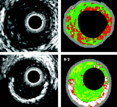 intravascular imaging ffr ultrasound ivus optical coherence tomography oct cath